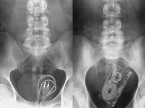 泌尿肛肠吃瓜,揭秘“吃瓜群众”的健康隐患